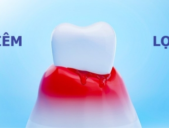Viêm lợi là gì? Cách chữa viêm lợi tại nhà hiệu quả