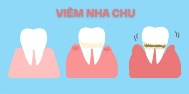 Các giai đoạn của viêm nha chu
